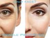 Can You Prevent Wrinkles Without Cosmetic Procedures Can You Prevent Wrinkles Without Cosmetic Procedures
